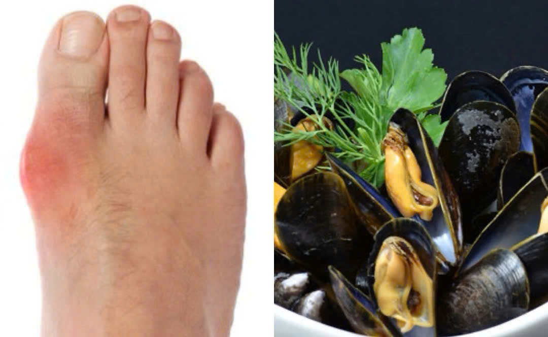Be careful when eating mussels because it increases uric acid. Graphics: Huong Giang