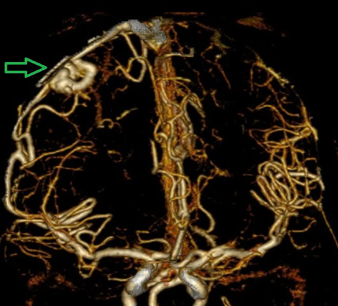 Hinh anh chup MSCT mach nao: Chay mau nao thuy dinh phai, chay mau nao that do vo AVM ( diem Spetzler Martin 2 diem) benh nhan nu, 29 tuoi. Anh: BSCC