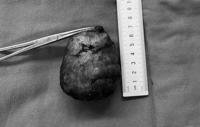 Khối u được phẫu thuật ra khỏi cơ thể người bệnh. Ảnh: BVCC