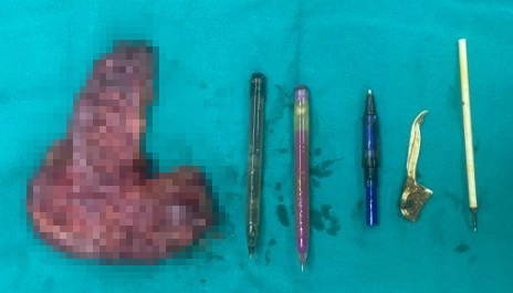 Foreign objects including pens, pen tips and plastic toothpicks... caused the patient's intestines to perforate. Photo: BVCC