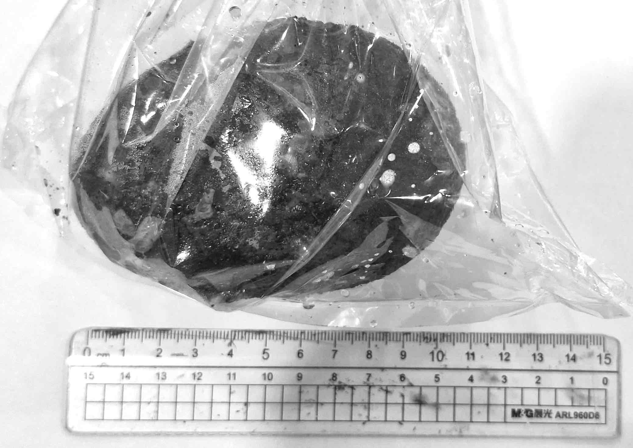 The gallstone was huge after surgery. Photo: Provided by the hospital