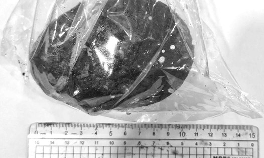 Viên sỏi có kích thước khủng sau khi được phẫu thuật. Ảnh: Bệnh viện cung cấp