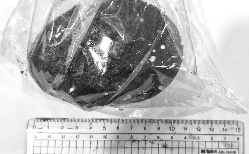 The gallstone was huge after surgery. Photo: Provided by the hospital