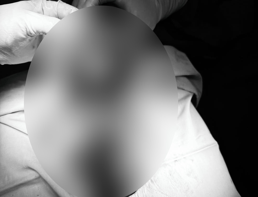 Vietnam - Cuba Friendship Hospital Dong Hoi has just successfully reattached the patient's nearly severed wrist. Photo: Vietnam - Cuba Friendship Hospital Dong Hoi.