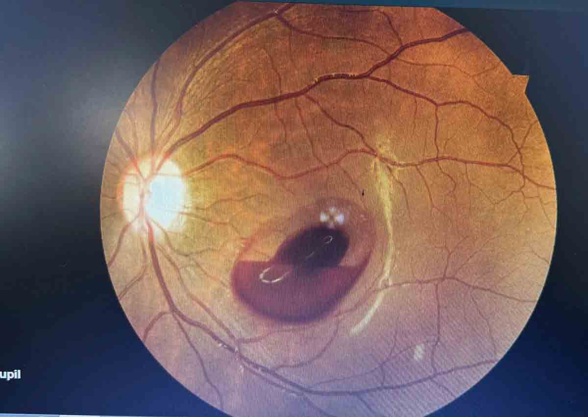 A's eyes lost vision due to laser beam. Photo: Anh Duong.