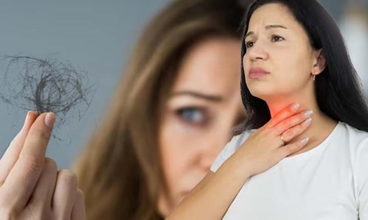 Rụng tóc có thể là dấu hiệu sớm của rối loạn tuyến giáp, đặc biệt là khi kèm theo các triệu chứng khác như mệt mỏi, thay đổi cân nặng. Đồ hoạ: Thiện Nhân