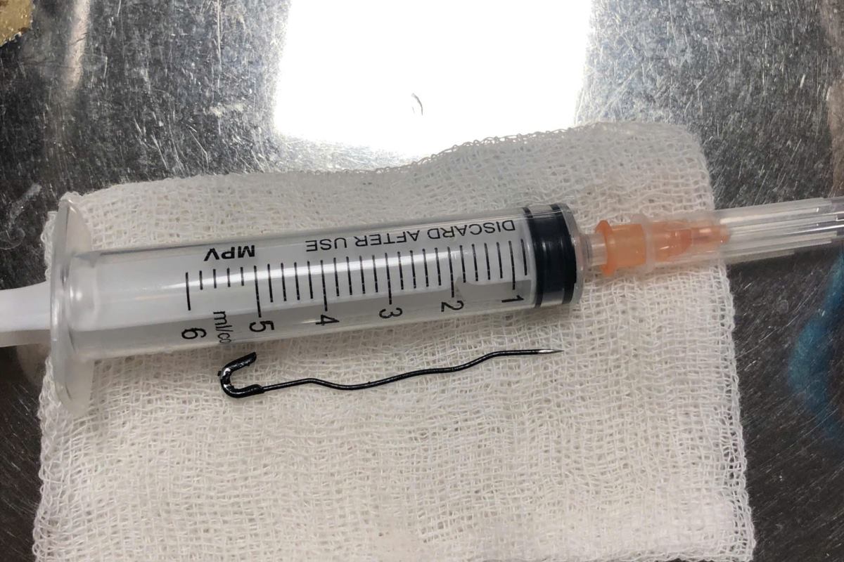 Child swallows 6cm long safety pin. Photo: Hai Phong Children's Hospital