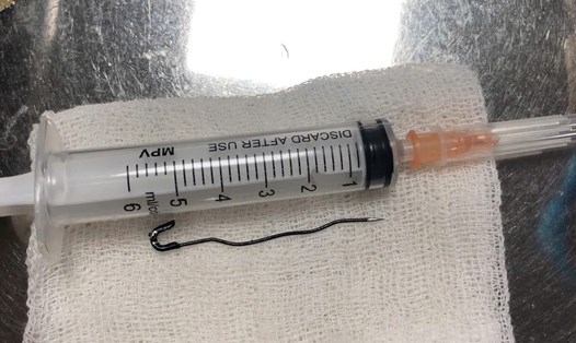 Trẻ nuốt phải kim băng nhọn dài 6 cm. Ảnh: Bệnh viện Trẻ em Hải Phòng