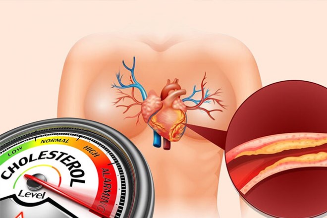 Controlling cholesterol in young people can help prevent long-term health problems. Graphics: Thien Nhan