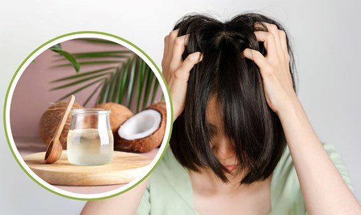 Dầu dừa giúp giảm ngứa da đầu. Đồ họa: Thanh Thanh