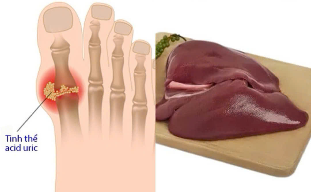 Pork liver increases uric acid and affects health. Graphics: Huong Giang