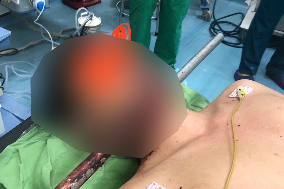 The male patient was stabbed through the cheek by a 1.2m long iron bar. Photo: D.Nguyen