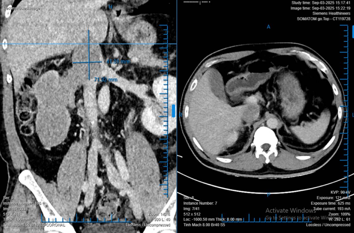 Hinh anh khoi ung thu bieu mo te bao than co huyet khoi buou tren phim CT-scan cua nguoi benh. Anh: Benh vien cung cap