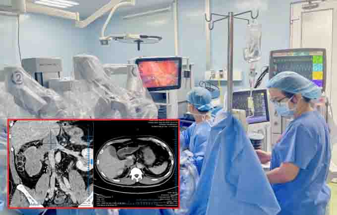 Robotic surgery to save a patient with a large kidney tumor.