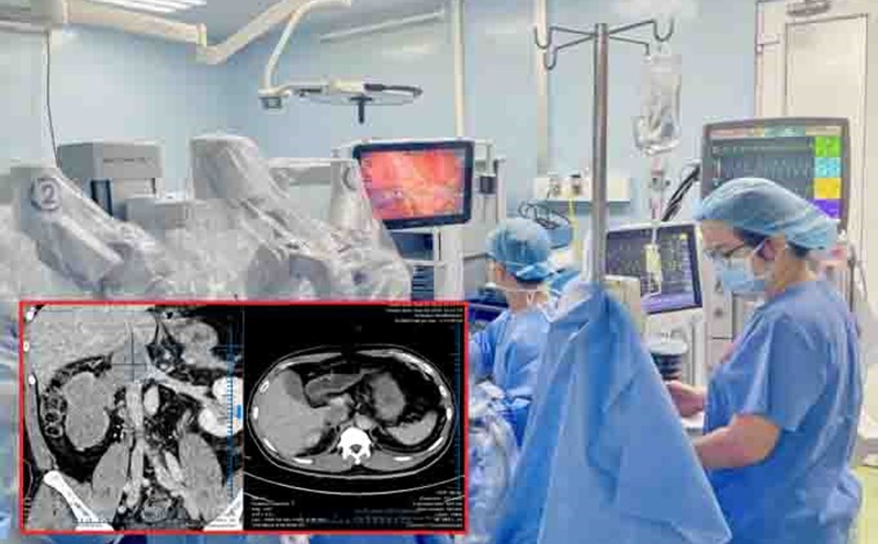 Robotic surgery to save a patient with a large kidney tumor.