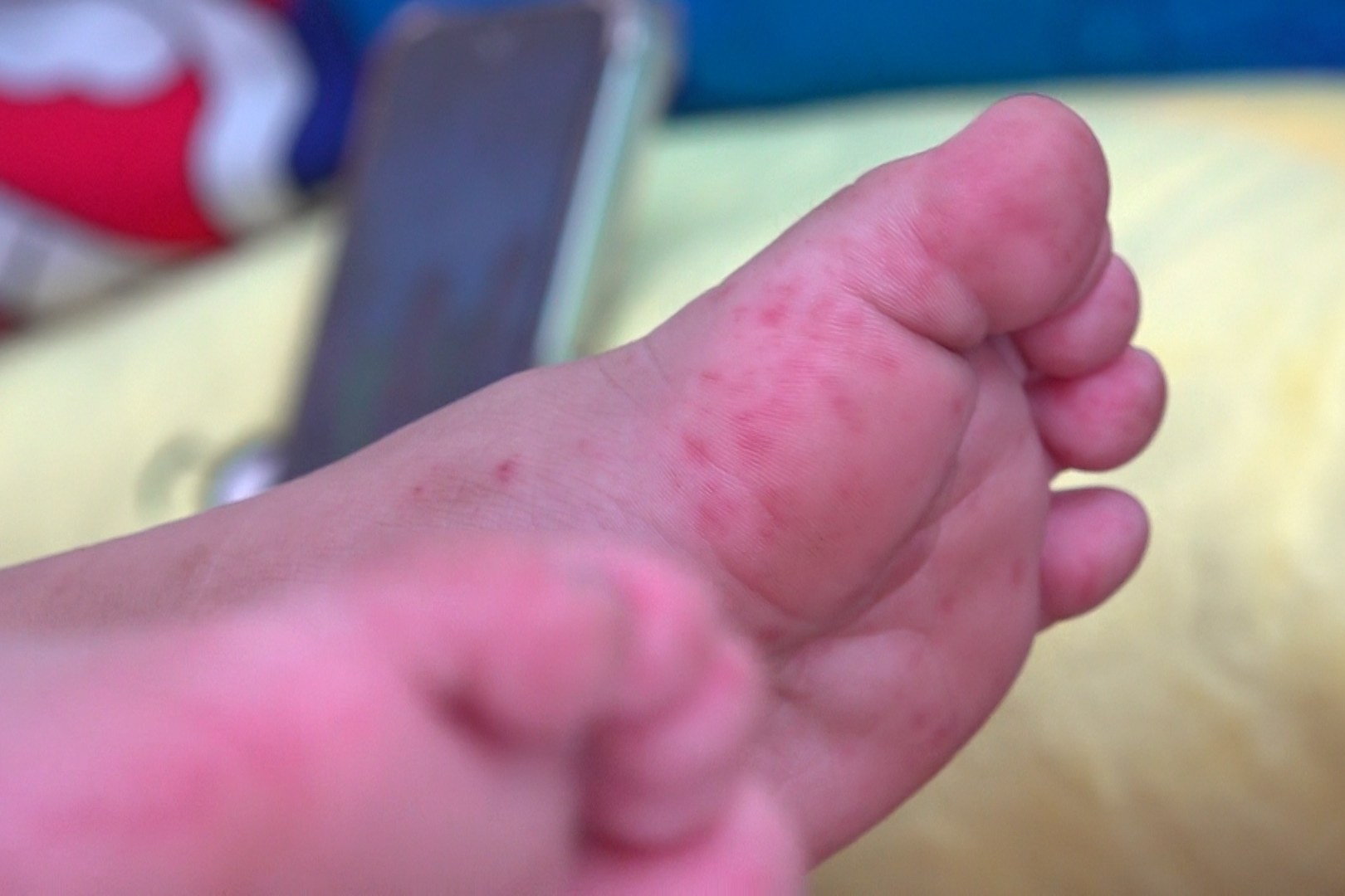 Hand, foot and mouth continue to increase in Can Tho