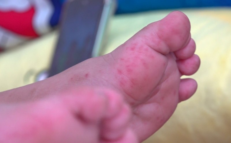 Hand, foot and mouth continue to increase in Can Tho