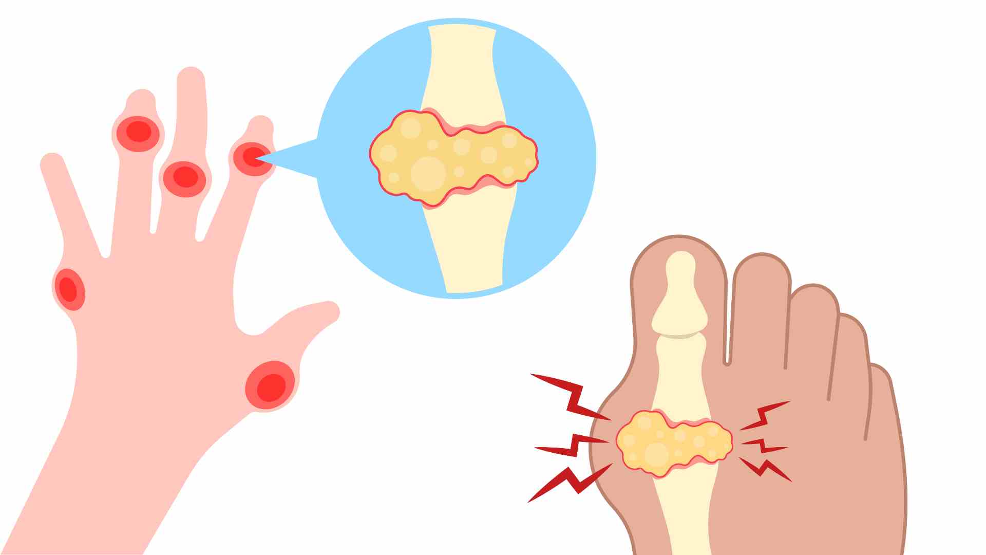 High uric acid levels are harmful to many tissues and organs. Graphics: Ha May
