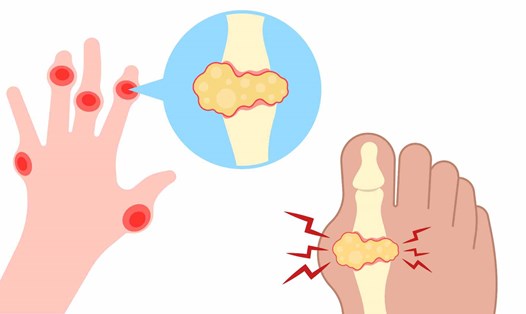 Nồng độ axit uric cao gây hại cho nhiều mô và cơ quan. Đồ họa: Hạ Mây