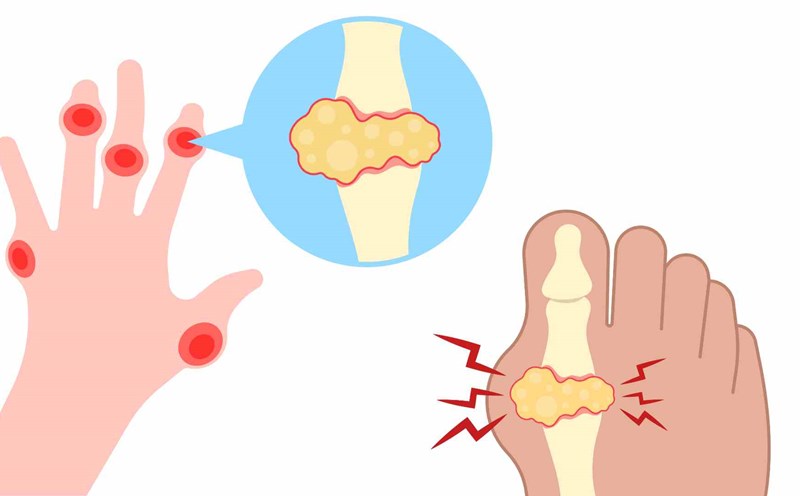 High uric acid levels are harmful to many tissues and organs. Graphics: Ha May
