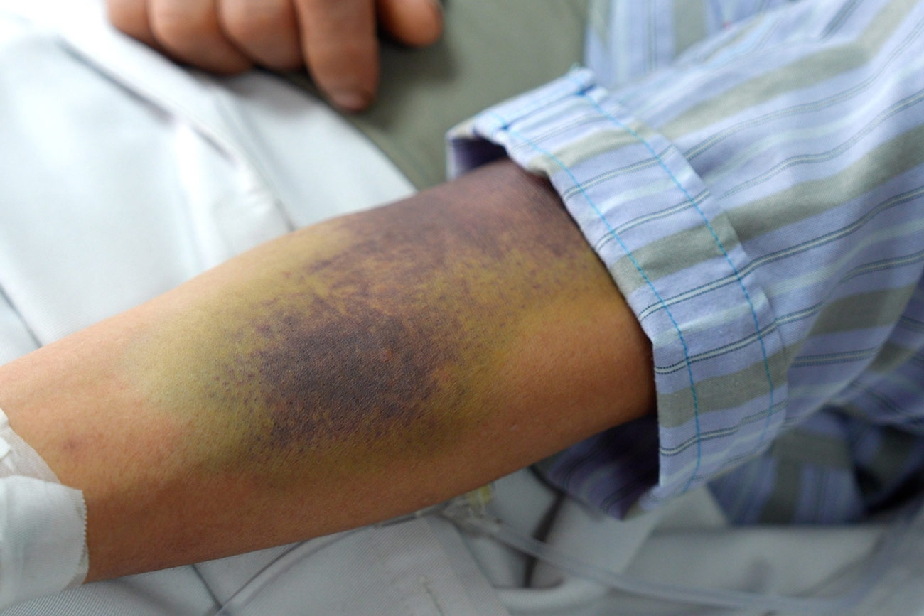 Proactively identifying the golden time, the key to reducing the consequences of dengue fever