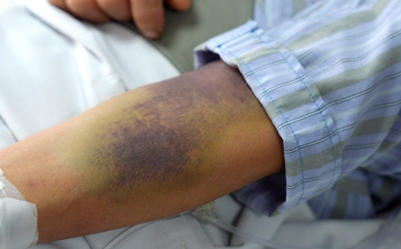 Proactively identifying the golden time, the key to reducing the consequences of dengue fever