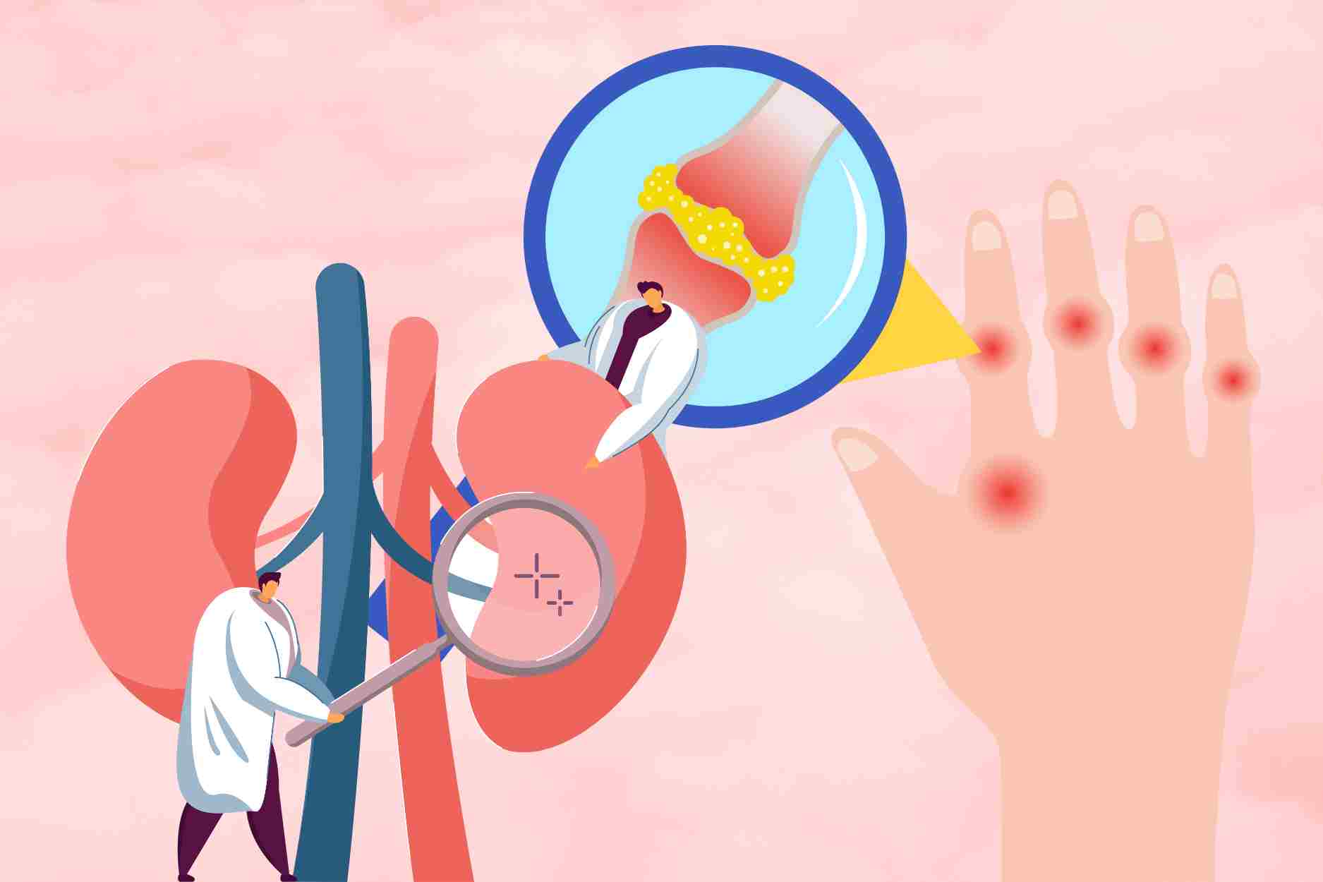 요산 수치를 낮추고 눈병을 예방하고 신장을 정화하는 3가지 간단한 방법