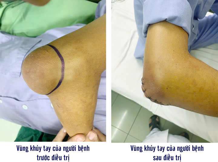 Chirurgie d'une grosse tumeur au coude due a la goutte de tophy. Photo : BVCC