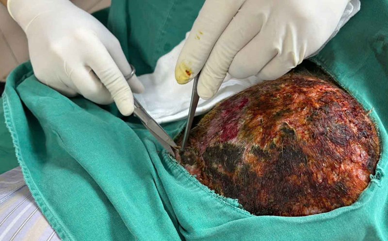 Believing the tips of applying shingles leaves to treat Hereafter, a patient was hospitalized with widespread ulcers and seizures