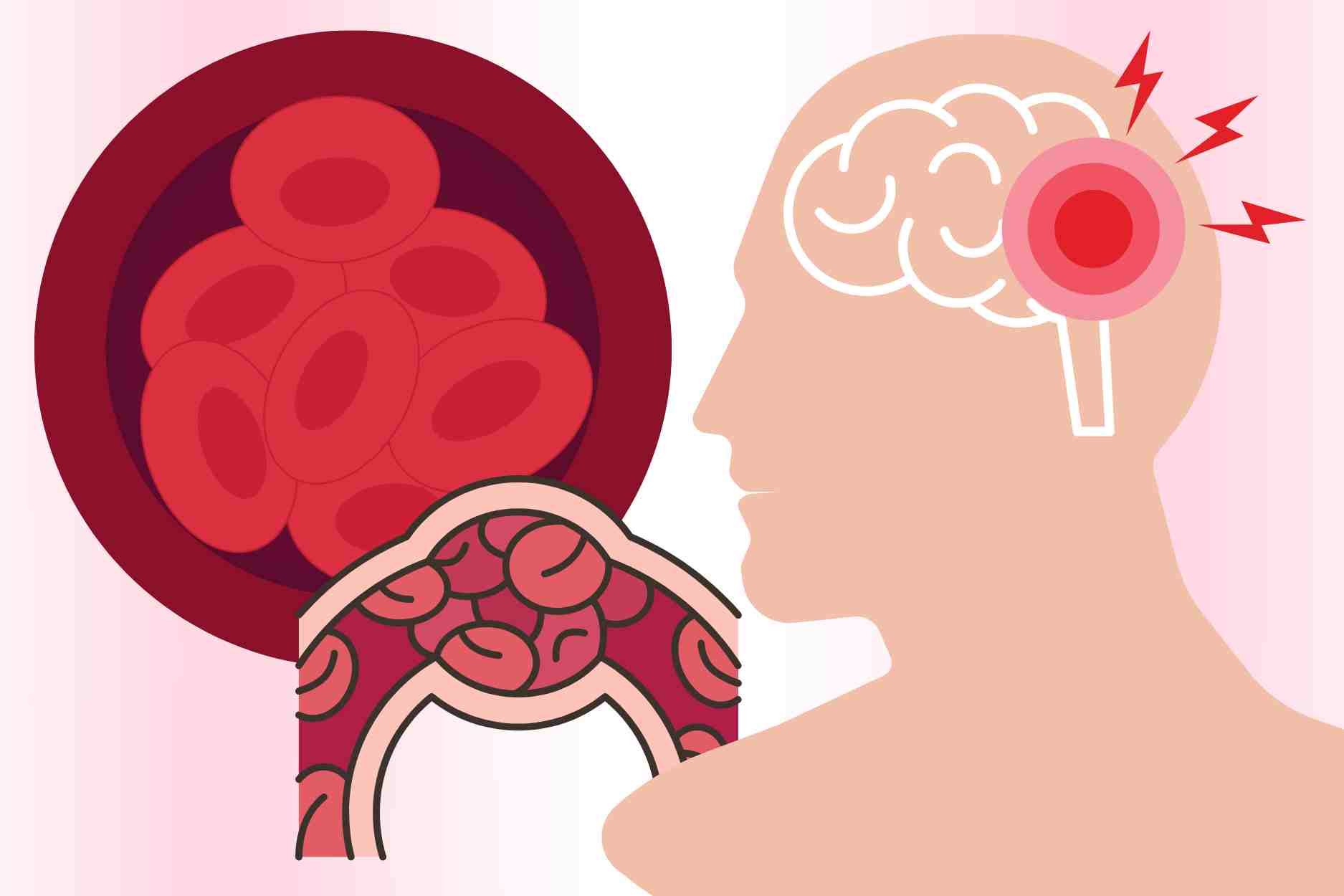 4 signs to help detect blood clots early, prevent stroke complications