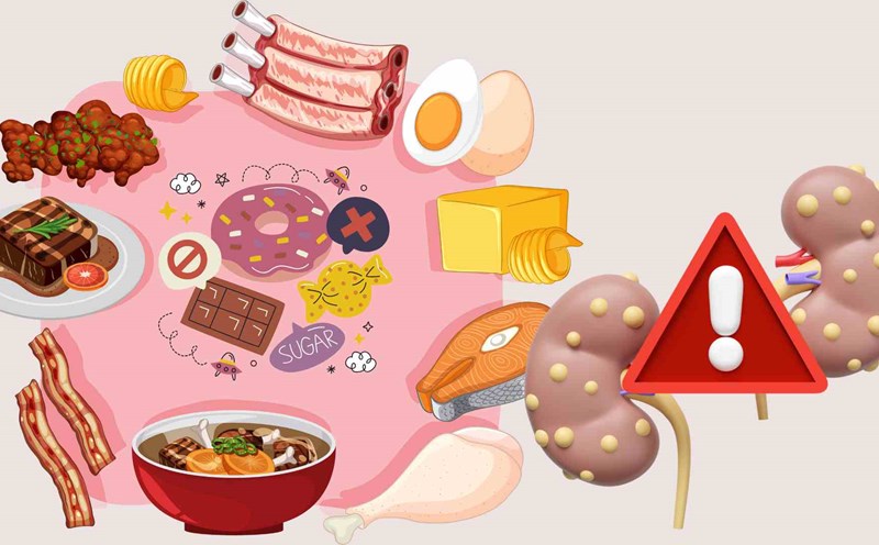 Unhealthy diets can cause kidney stones. Graphics: Ha May