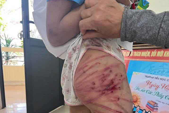 The image posted on Facebook account Phan Thi Kim Oanh said that the child was beaten by her stepfather and had to be hospitalized.