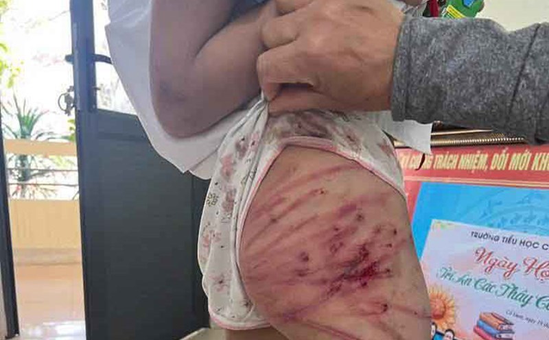 The image posted on Facebook account Phan Thi Kim Oanh said that the child was beaten by her stepfather and had to be hospitalized.