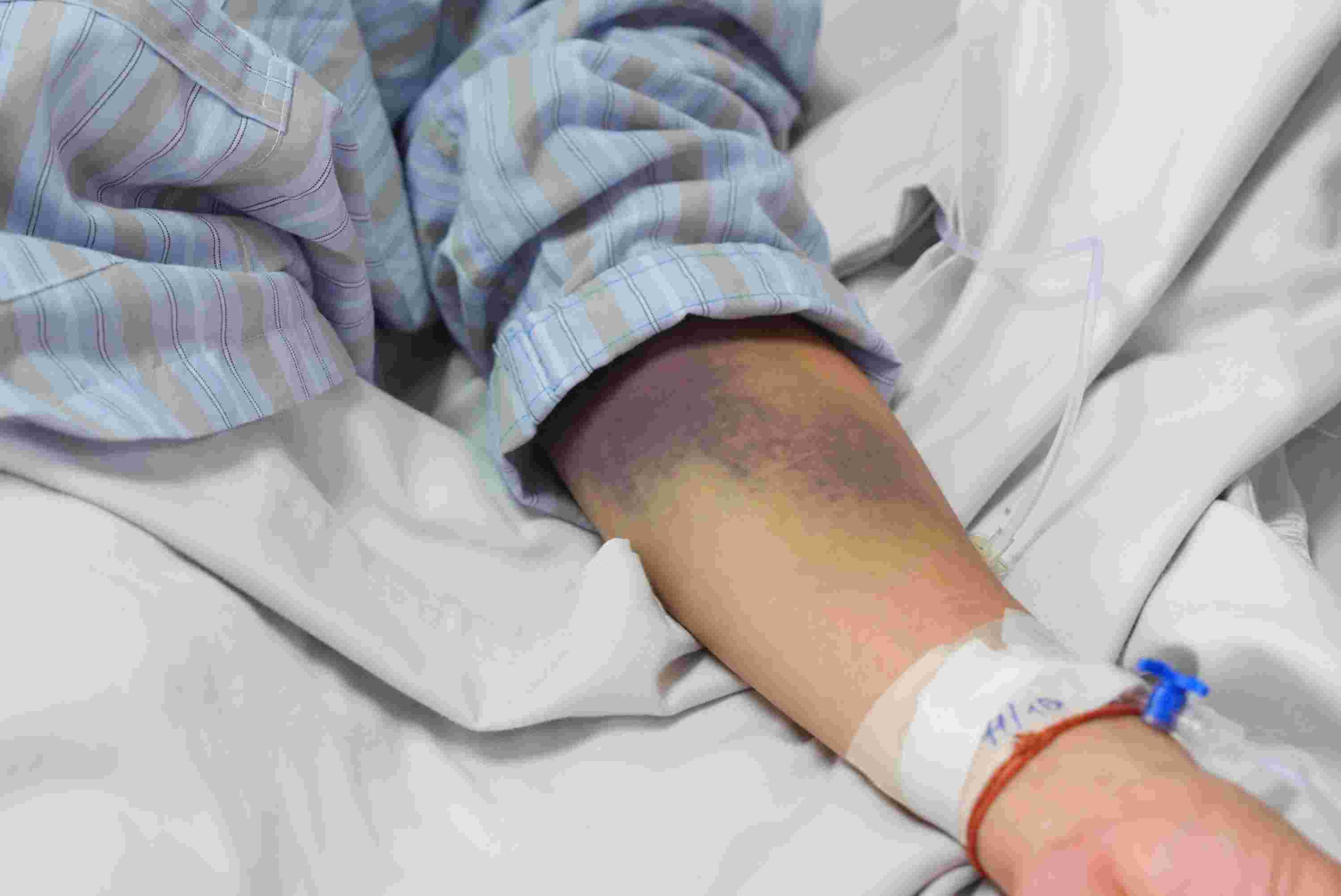 The patient had subcutaneous bleeding due to dengue fever. Photo: Dinh Hiep