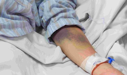 Bệnh nhân bị xuất huyết dưới da do sốt xuất huyết. Ảnh: Đinh Hiệp