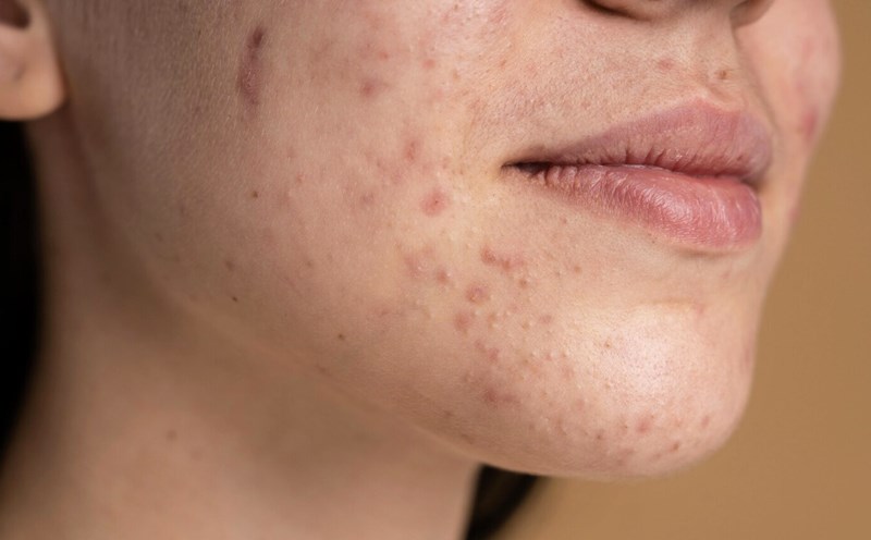 Use neem properly to treat acne. Photo: Thuy Duong