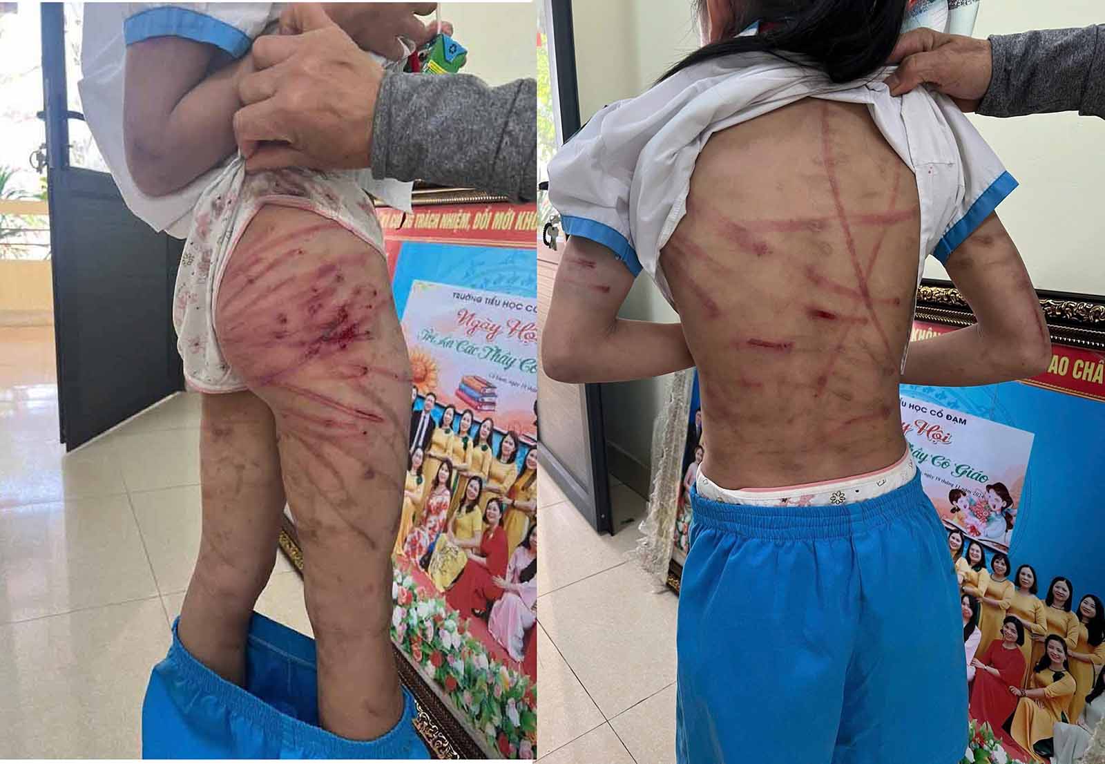 Nam 2024, khi L di hoc da duoc co giao phat hien toan than em chi chut vet bam tim do bi cha duong la Nguyen Van Nam danh. Anh: Tuan Hiep.