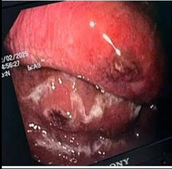 胃と食道を侵食した稀な細菌に苦しむ男性の命を救った。写真：BVCC