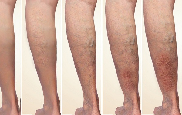 Lower limb varicose veins: Understand correctly for effective prevention and treatment. Photo: BVCC