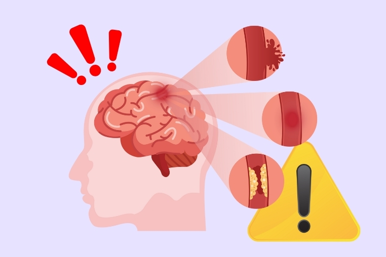 Warning signs of stroke that should never be ignored