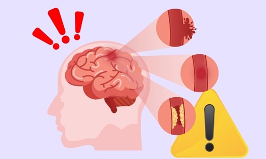 Dấu hiệu cảnh báo đột quỵ tuyệt đối không nên bỏ qua