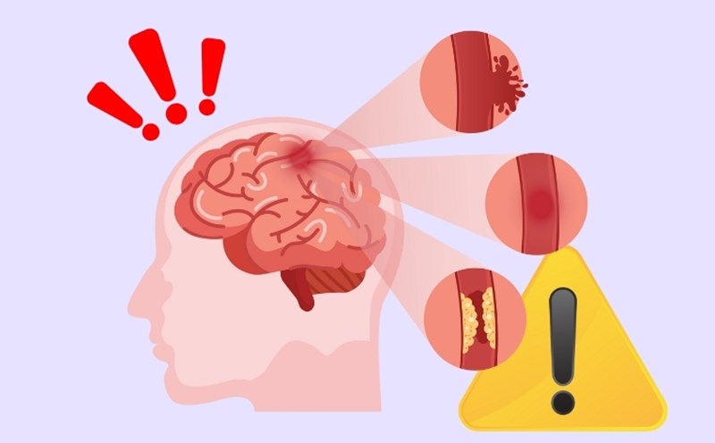 Signos de advertencia de un derrame cerebral que absolutamente no debes ignorar