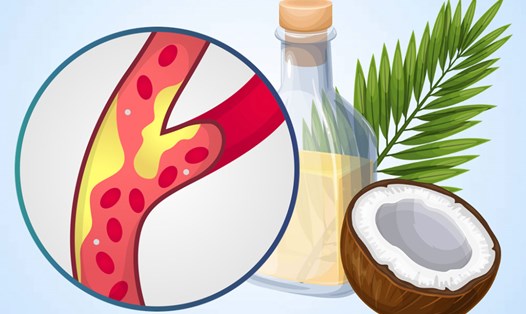 Tác động của sữa dừa đến mức cholesterol trong cơ thể. Đồ họa: Thiện Nhân