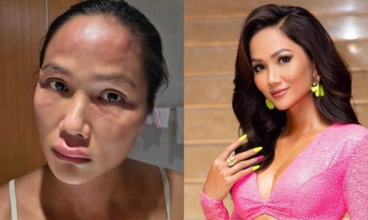 Hoa hậu H'Hen Niê chia sẻ về tình trạng bệnh lý. Ảnh: Nhân vật cung cấp.