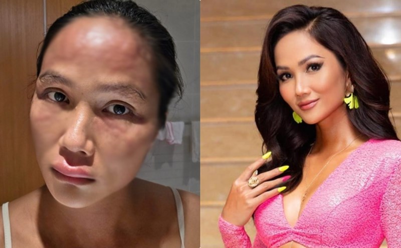 Miss H'Hen Nie shares about her medical condition. Photo: Provided by the character.