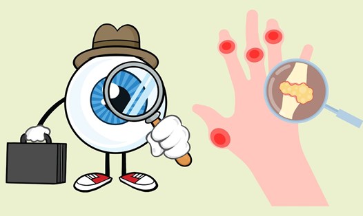 Nhìn mắt đoán axit uric cao. Đồ họa: Linh Đan