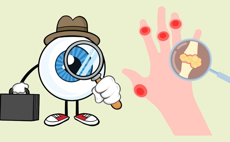 Looking at the eyes predicts high uric acid. Graphics: Linh Dan