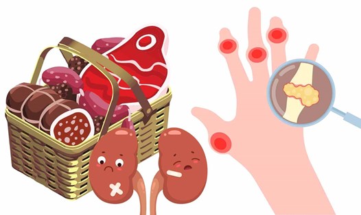 Thịt đỏ có thể làm tăng axit uric và suy thận. Đồ họa: Hạ Mây