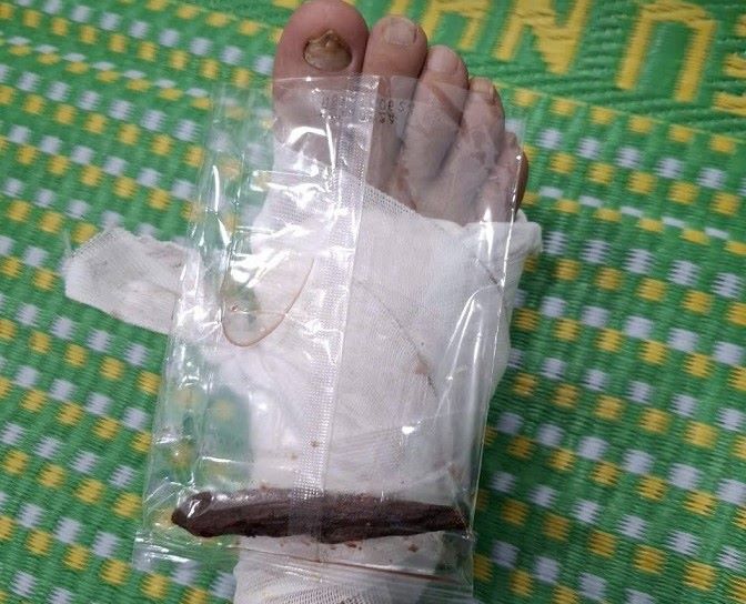 ディン・クアン・ティエン中佐 - クアンガイ省ソンタイコミューン警察署長は、人々を助ける任務中、木の棒で足を突き刺された。写真: クアンガイ県警察