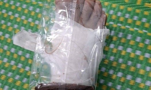 Thượng tá Đinh Quang Tiến - Trưởng Công an xã Sơn Tây, tỉnh Quảng Ngãi trong khi đi làm nhiệm vụ giúp đỡ dân bị một cây gỗ đâm xuyên bàn chân. Ảnh: Công an tỉnh Quảng Ngãi